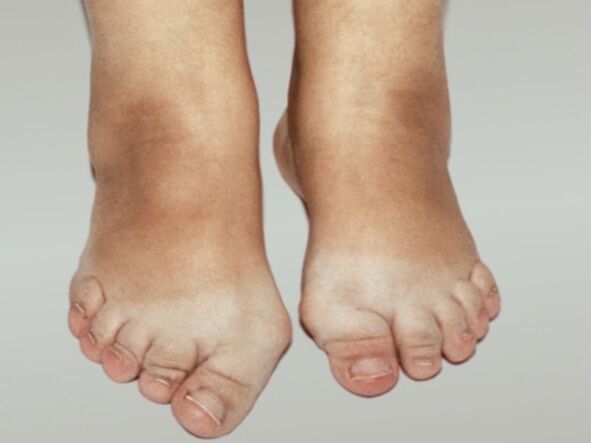 Arthrose du pied avec déformation sévère des orteils. 