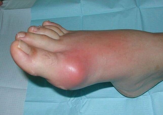 Tableau clinique de gonflement et d’inflammation de l’arthrite du pied. 