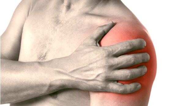 Une épaule enflée, rouge et élargie, symptômes d'arthrose de l'articulation de l'épaule de grade 2-3
