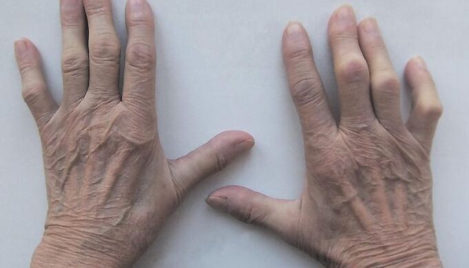 douleur articulaire aux doigts
