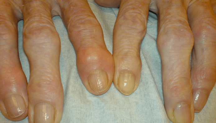 douleur articulaire des doigts avec arthrose