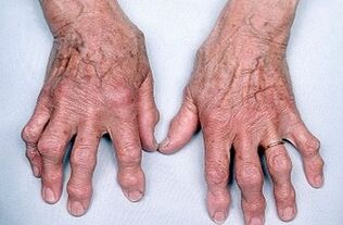 comment se débarrasser des douleurs articulaires des doigts