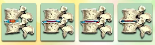 Les phases de Développement de l'Ostéochondrose