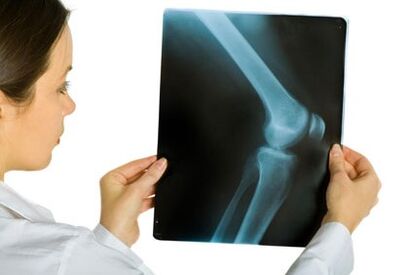 Traitement de l'arthrose articulaire du genou