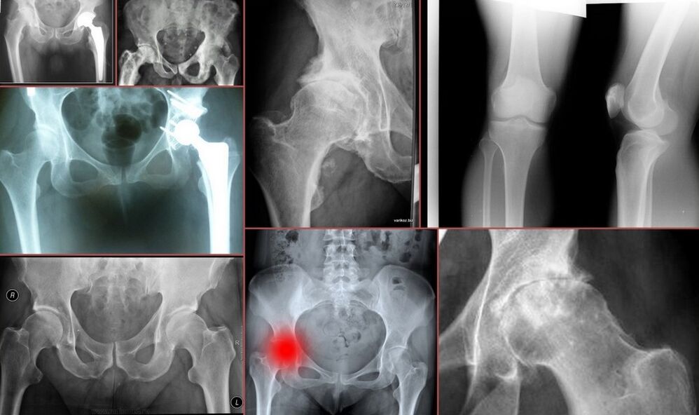 radiographie pour douleur à la hanche