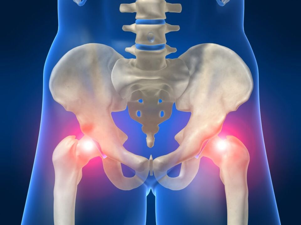 Dans la spondylarthrite ankylosante, les douleurs articulaires bilatérales de la hanche sont gênantes. 