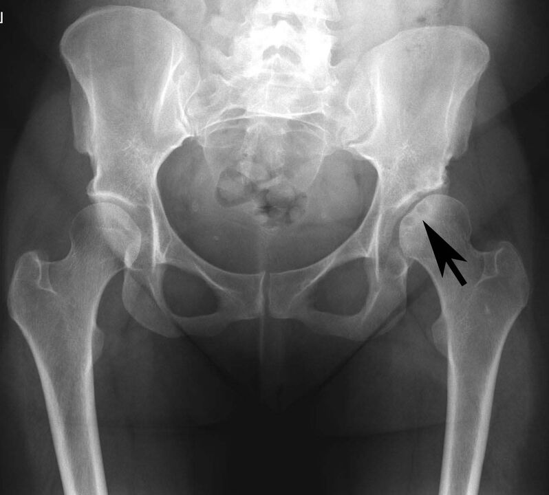 Dépôt de sels de calcium dans l'articulation de la hanche avec pseudogoutte à la radiographie